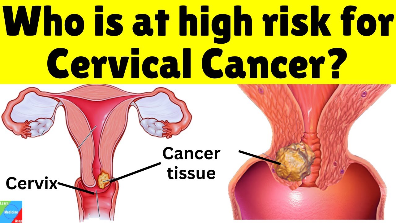 Healthy Women Are Still Getting Cervical Cancer — Here’s Why