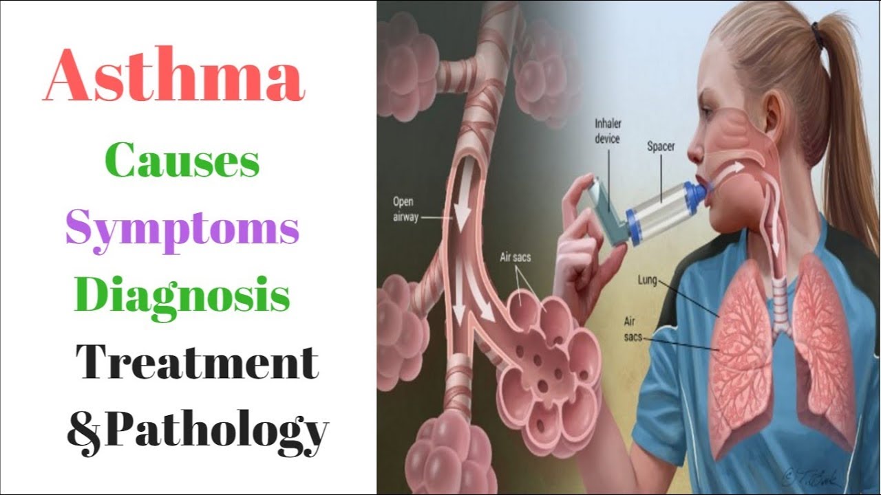 Unbelievable Asthma Biologics & Inhalers Explained