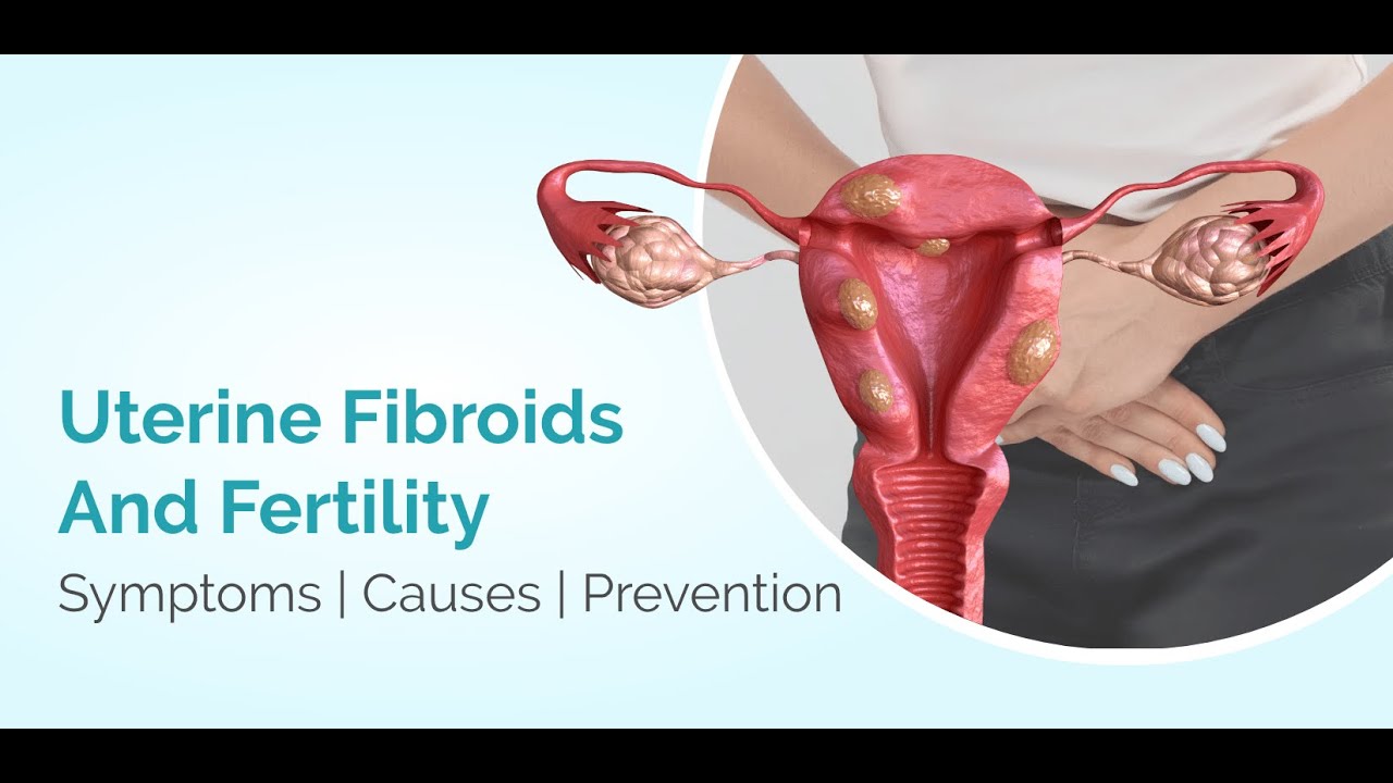 Unbelievable Fibroid Mistakes Ruining Women’s Fertility