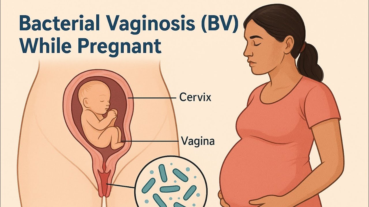 Bacterial Vaginosis During Pregnancy: The Silent Risk to Your Baby