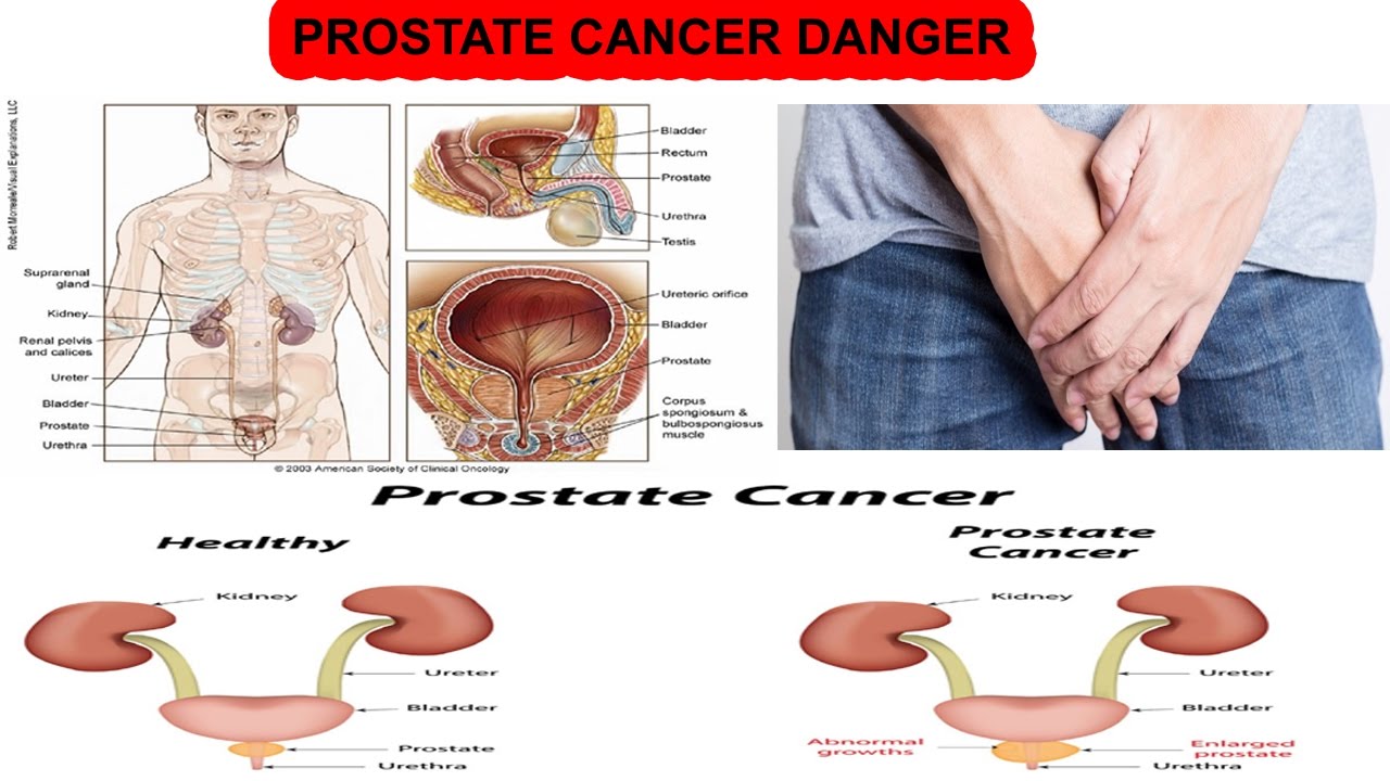 The Shocking Habit Raising Prostate Cancer Risk