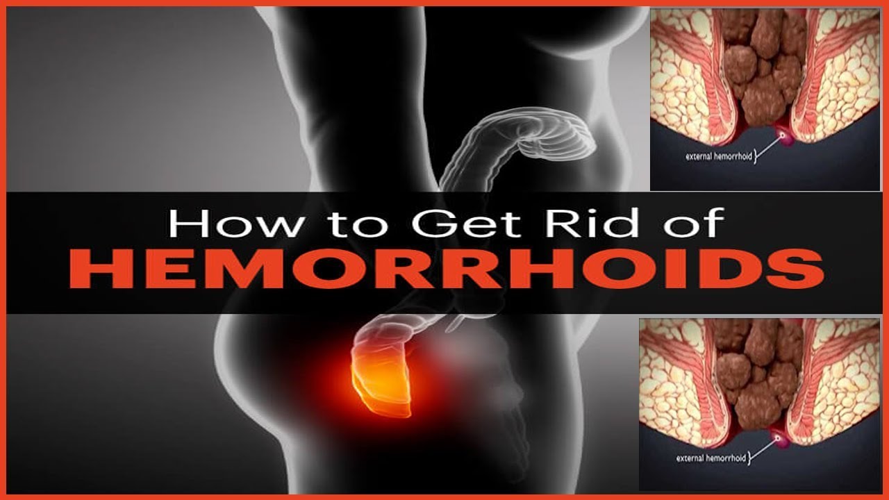 “Untreated Hemorrhoids at Midlife: The Shocking Truth”