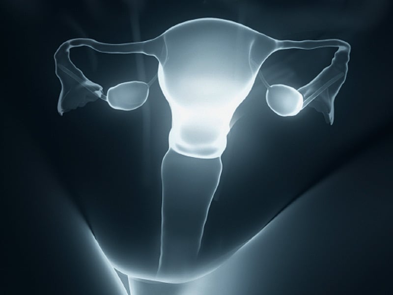Ovaries Removed or Preserved? A Risky Hysterectomy Decision