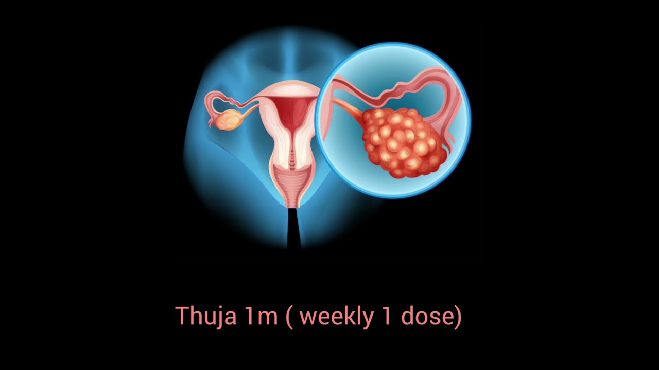 PCOS Fertility Treatment Options Doctors Rarely Explain