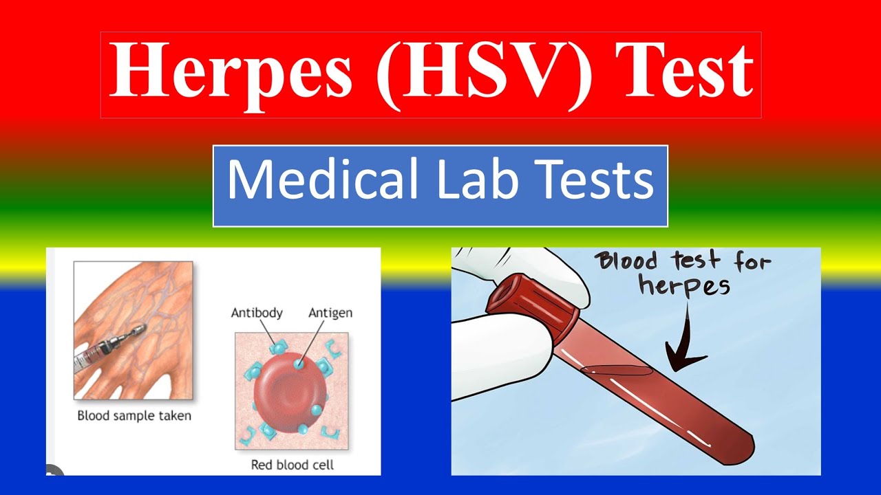Herpes Blood Test Accuracy Exposed:What to Do Instead