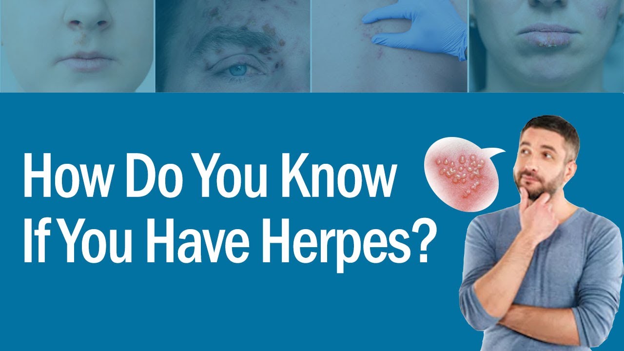 Herpes Without Symptoms: What Doctors Don’t Tell You