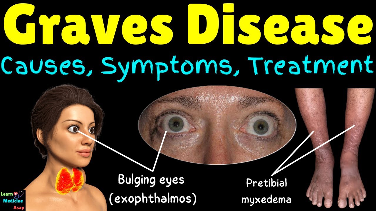 Graves’ Eye Disease Warning Signs — Shocking Early Symptoms