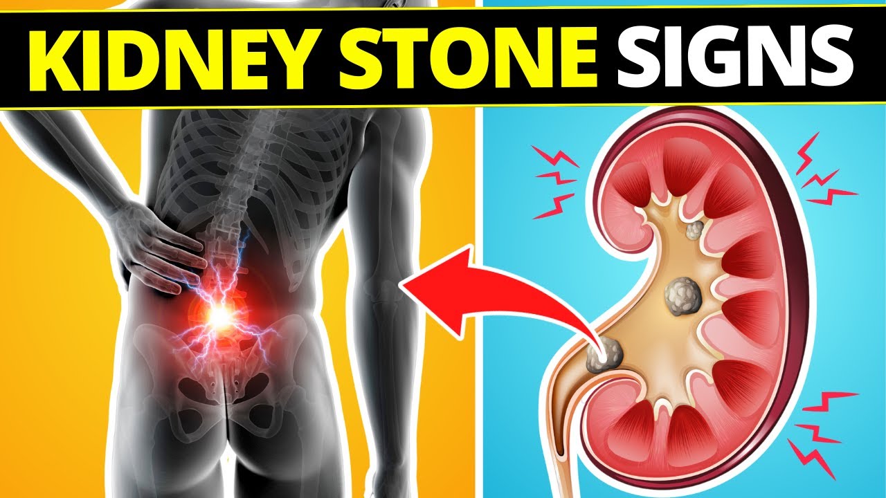 The Hidden Early Signs of Kidney Stones Doctors Don’t Tell You