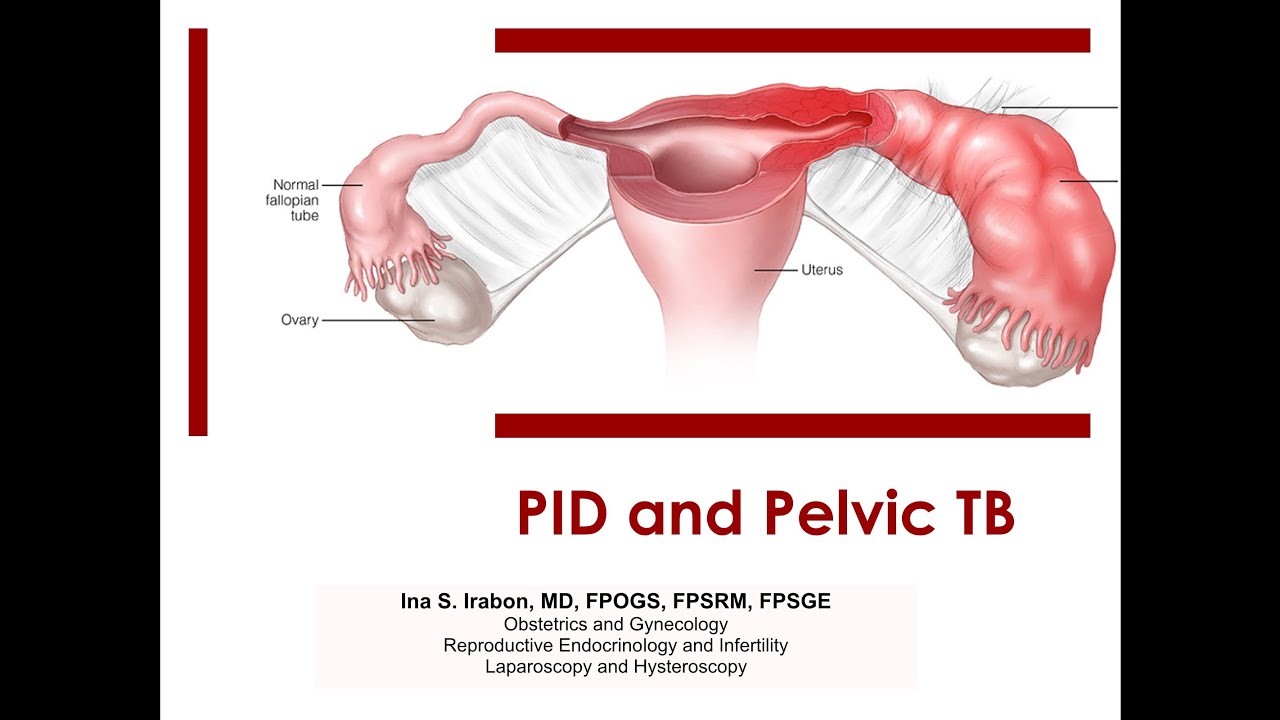 The Shocking Link Between Douching and PID