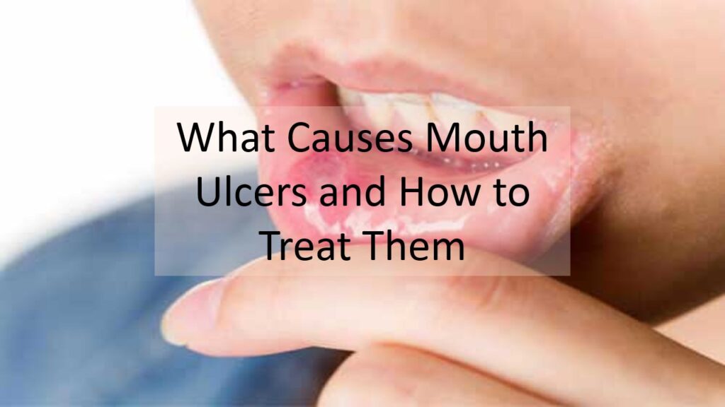 Mouth Ulcers Explained: Triggers, Treatment & Prevention