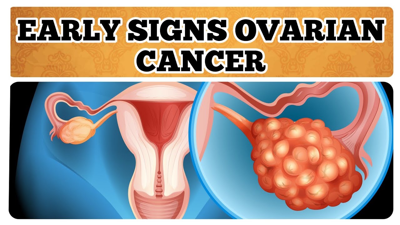 Unbelievable Early Ovarian Cancer Signs Most Women Ignore