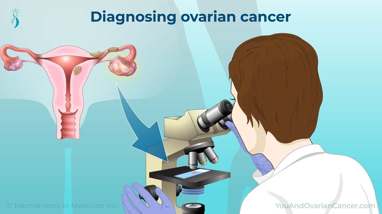 Shocking Ovarian Cancer Mistakes at Routine Checkups